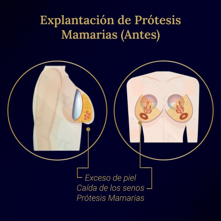 Explantación Prótesis Mamarias Antes