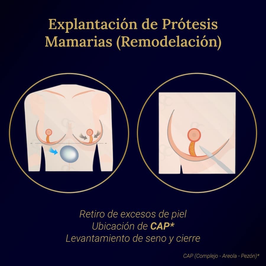 Explantación Prótesis Mamarias Remodelación