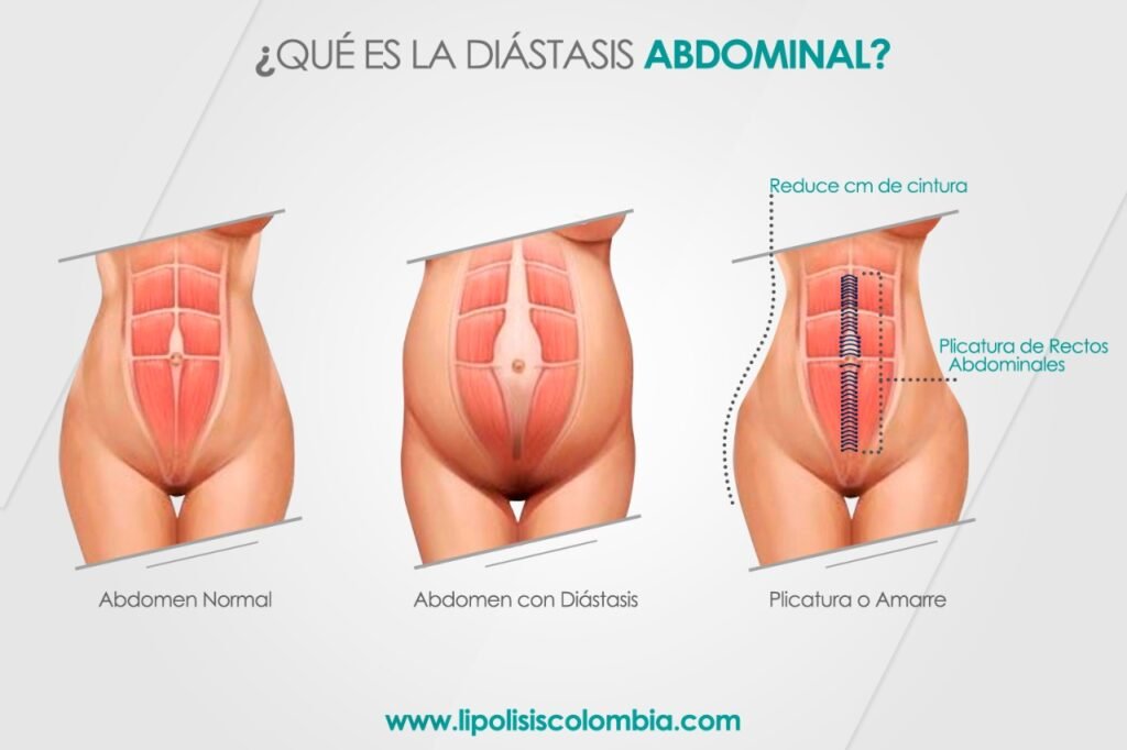 Amarre de los Músculos Abdominoplastia Bogotá