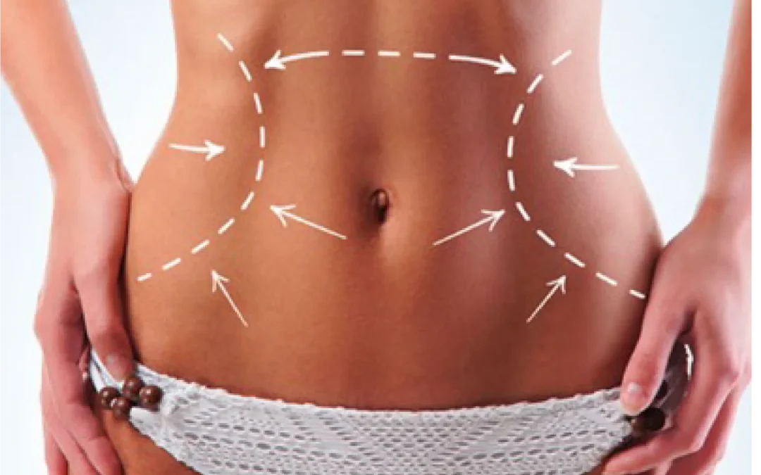 Lipólisis con Abdominoplastia Bogotá o Lipoabdominoplastia