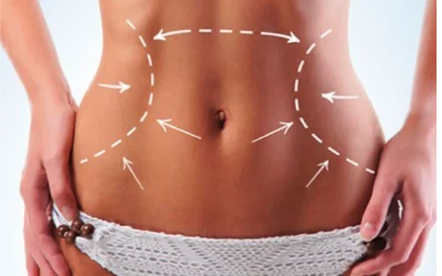 Lipólisis con Abdominoplastia Bogotá o Lipoabdominoplastia