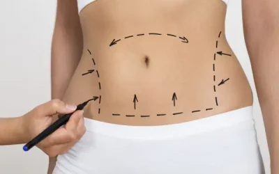 Abdominoplastia Bogotá o Cirugía de Abdomen